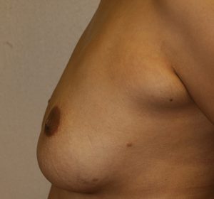 Liposuction of Axillary Rolls