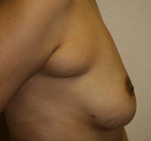 Liposuction of Axillary Rolls