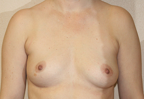 Liposuction of Axillary Rolls