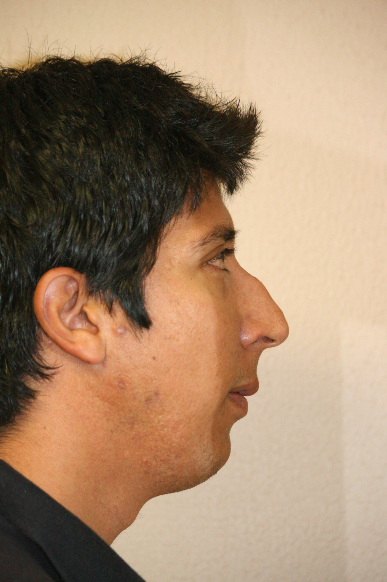 Male Rhinoplasty