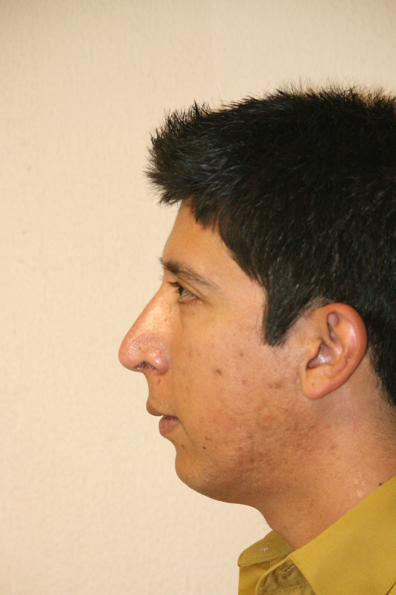 Male Rhinoplasty