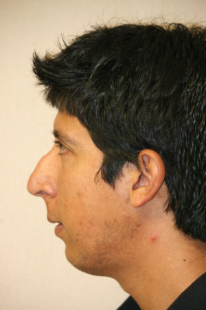 Male Rhinoplasty