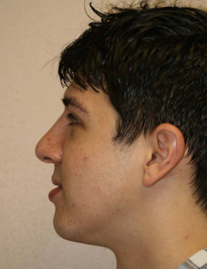 Male Rhinoplasty