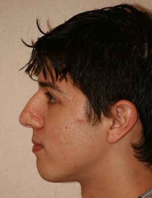 Male Rhinoplasty