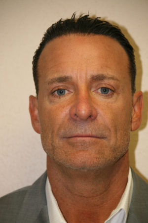 Male Rhinoplasty Case 7635 After Photo Male Rhinoplasty
