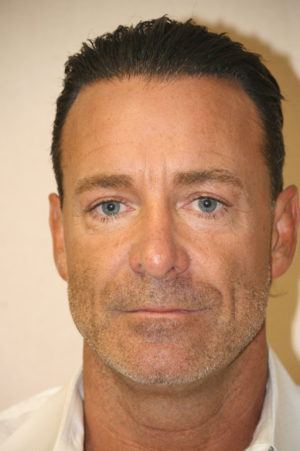 Male Rhinoplasty Case 7635 Before Photo Male Rhinoplasty