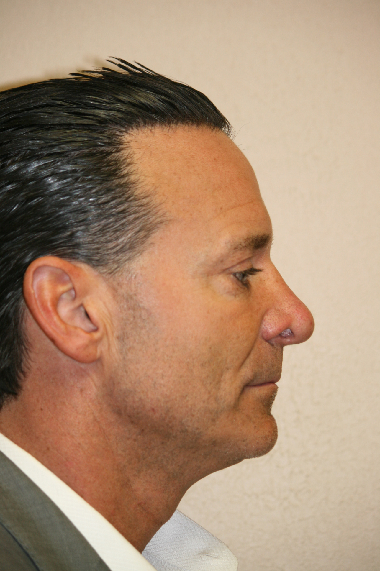 Male Rhinoplasty