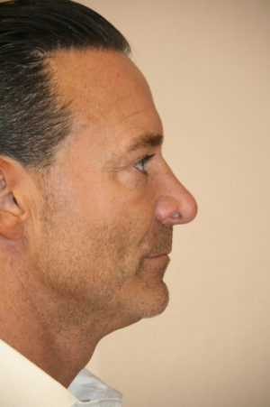 Male Rhinoplasty Case 7635 Before Photo Male Rhinoplasty