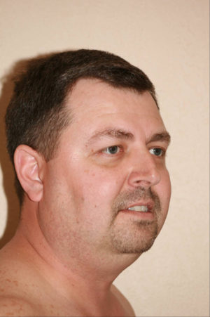 Male Rhinoplasty Case 7650 Before Photo Male Rhinoplasty