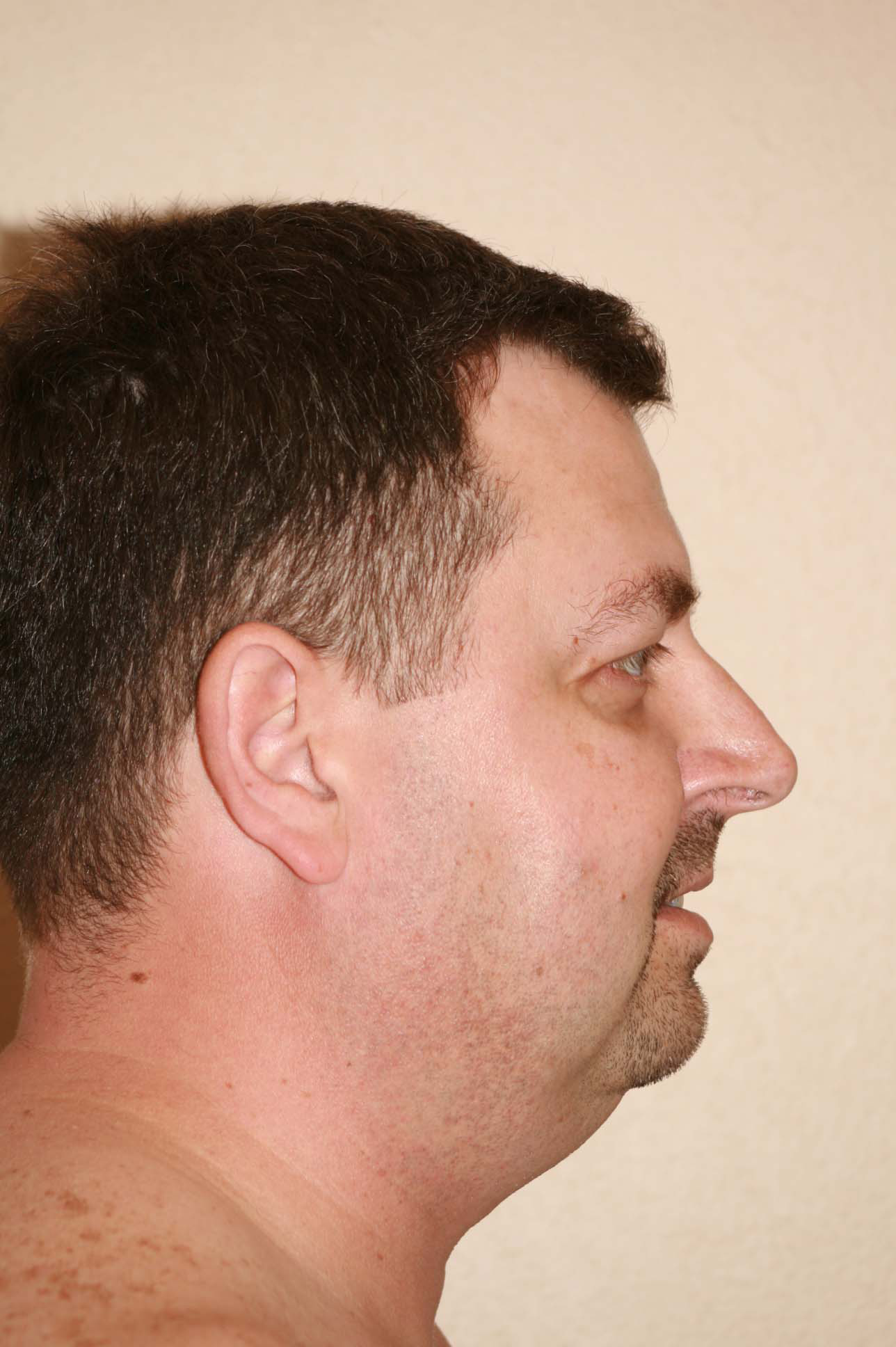 Male Rhinoplasty