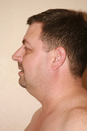 Male Rhinoplasty Case 7650 Before Photo Male Rhinoplasty