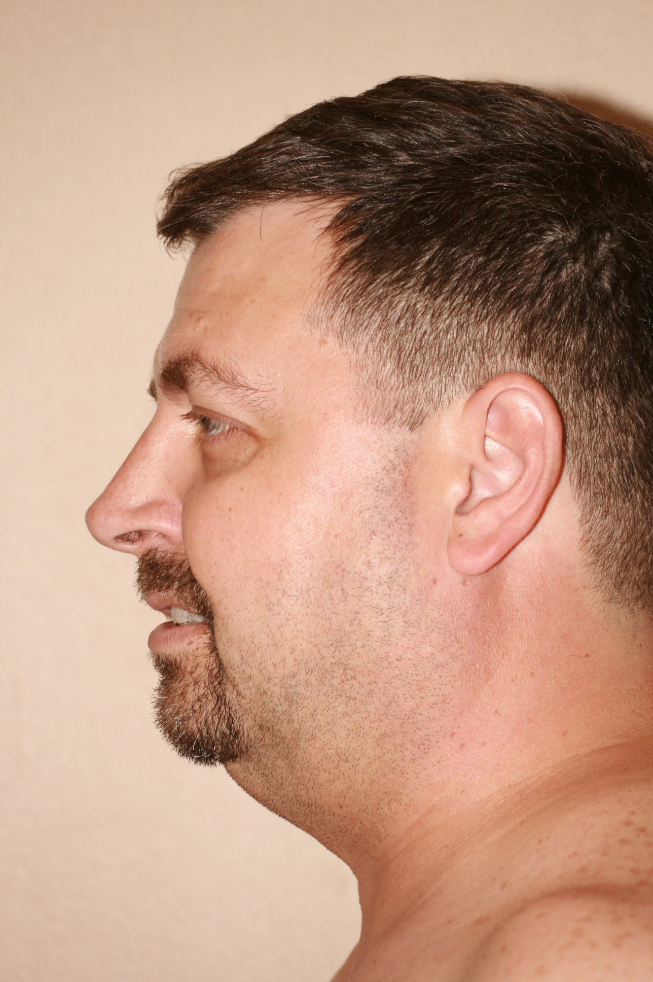 Male Rhinoplasty