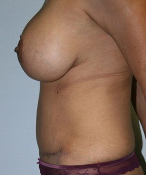 Mommy Makeover Case 7680 After Photo Mommy Makeover
