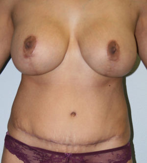 Mommy Makeover Case 7680 After Photo Mommy Makeover