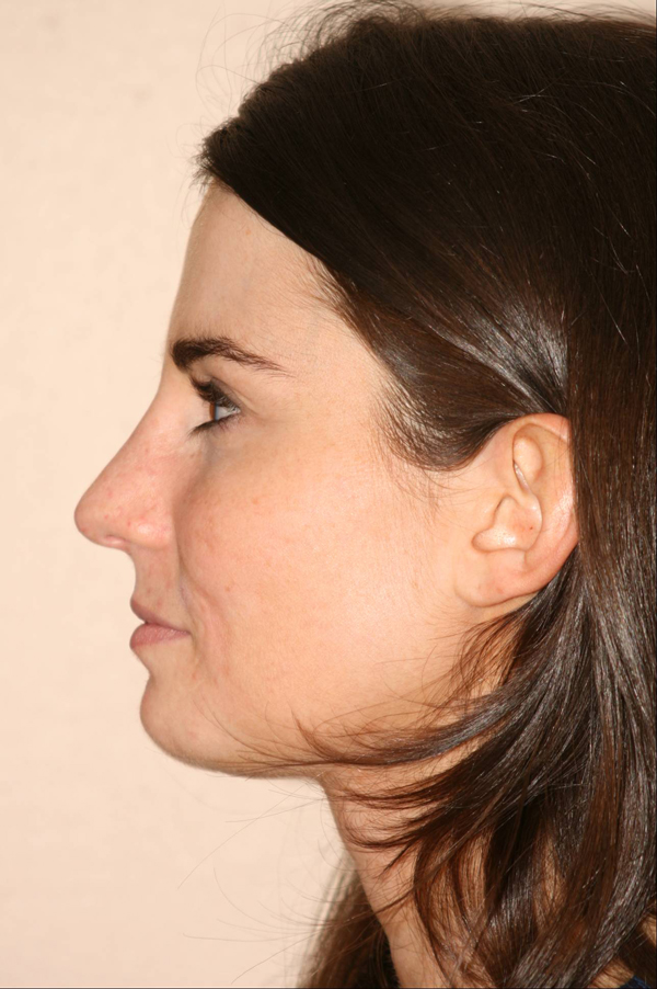 Rhinoplasty