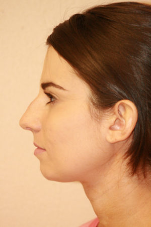 Rhinoplasty Case 7778 Before Photo Rhinoplasty