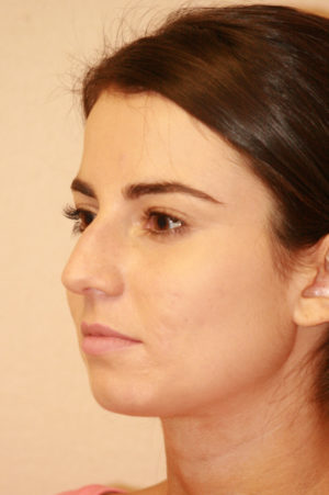 Rhinoplasty Case 7778 Before Photo Rhinoplasty