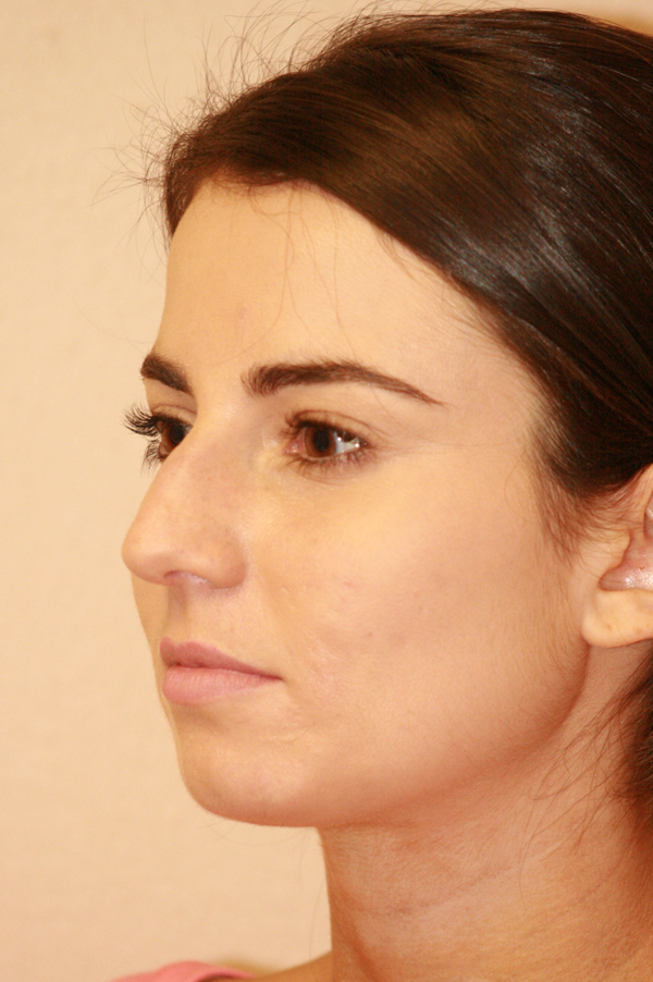 Rhinoplasty