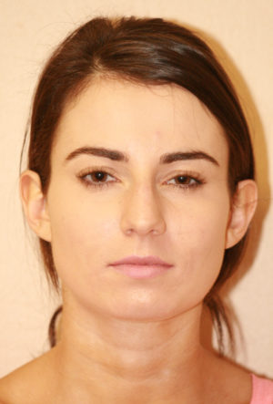 Rhinoplasty Case 7778 Before Photo Rhinoplasty