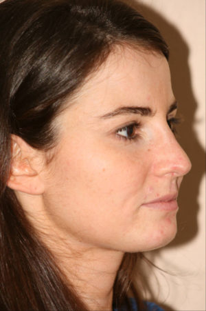 Rhinoplasty Case 7778 After Photo Rhinoplasty