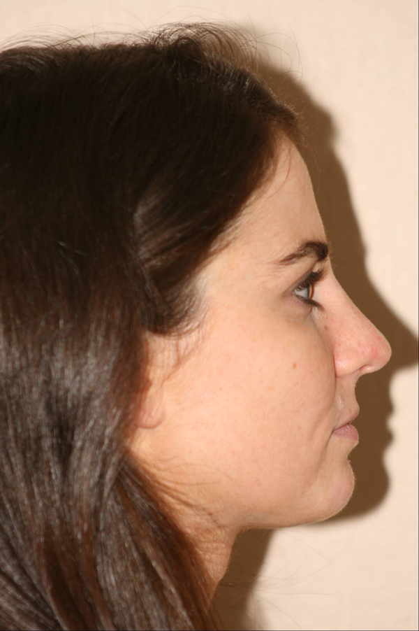 Rhinoplasty