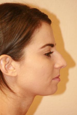Rhinoplasty Case 7778 Before Photo Rhinoplasty