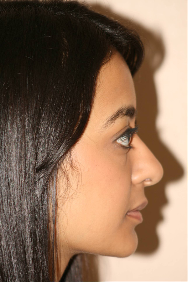 Rhinoplasty