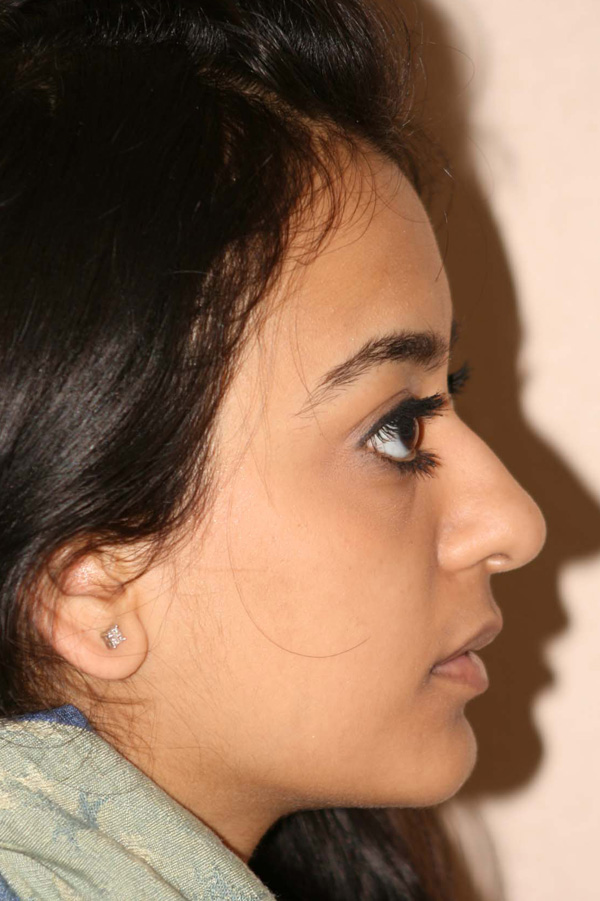 Rhinoplasty