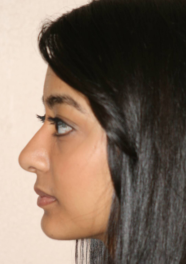 Rhinoplasty