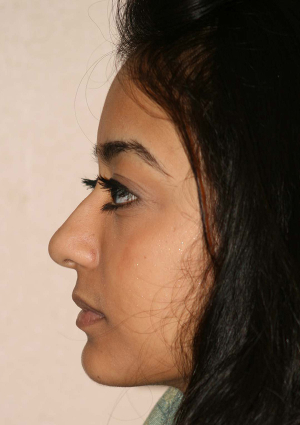 Rhinoplasty