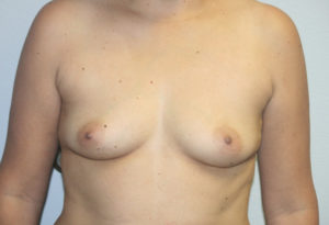 Breast Augmentation