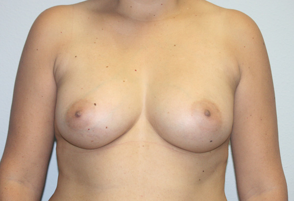 Breast Augmentation