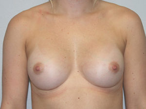 Breast Augmentation Case 7902 After Photo Breast Augmentation