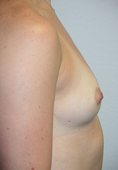 Breast Augmentation Case 7902 Before Photo Breast Augmentation