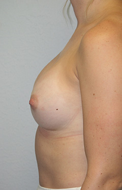 Breast Augmentation Case 7902 After Photo Breast Augmentation