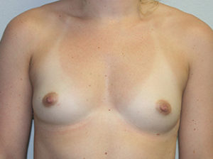 Breast Augmentation Case 7902 Before Photo Breast Augmentation