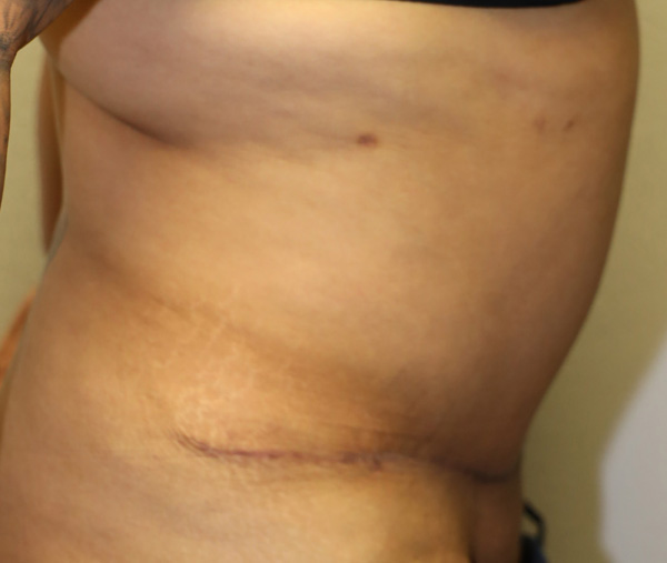 Tummy Tuck (Abdominoplasty)