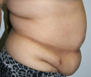 Tummy Tuck (Abdominoplasty)