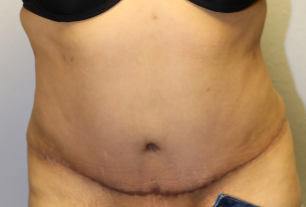 Tummy Tuck (Abdominoplasty)