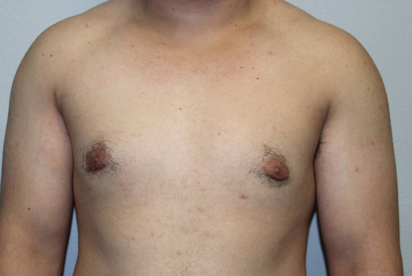 Gynecomastia (Male Breast Reduction)