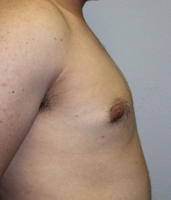 Gynecomastia (Male Breast Reduction)