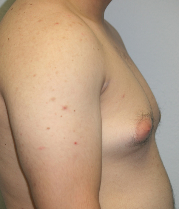 Gynecomastia (Male Breast Reduction)