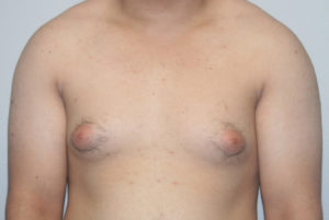 Gynecomastia (Male Breast Reduction)