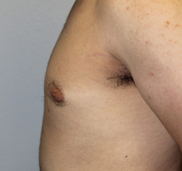 Gynecomastia (Male Breast Reduction)