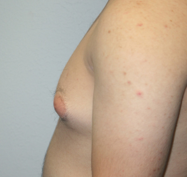 Gynecomastia (Male Breast Reduction)