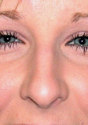 Rhinoplasty Case 7939 Before Photo Rhinoplasty