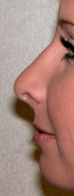 Rhinoplasty Case 7939 After Photo Rhinoplasty