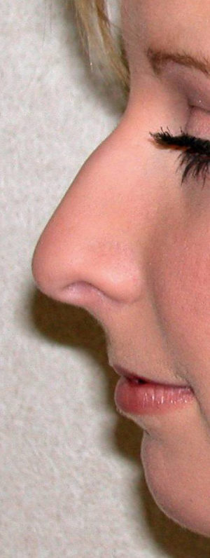 Rhinoplasty Case 7939 Before Photo Rhinoplasty