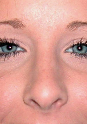 Rhinoplasty Case 7939 After Photo Rhinoplasty