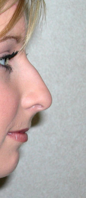 Rhinoplasty Case 7939 Before Photo Rhinoplasty